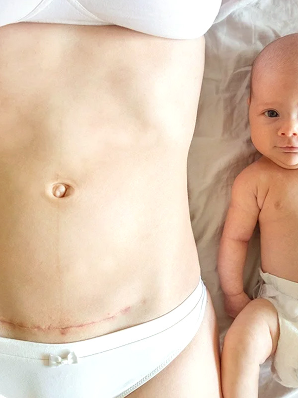 Previjanje i nega rane